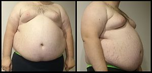 A front and side view of a "super obese" male torso. Stretch marks of the skin are visible along with gynecomastia.