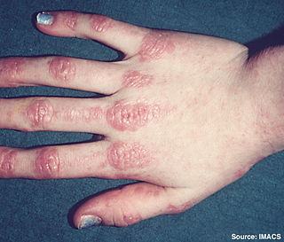 Dermatomyositis.jpg