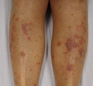 Lichen Planus (2).JPG