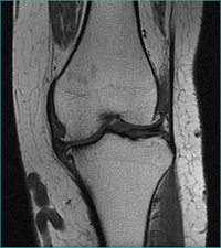 MRI of a knee