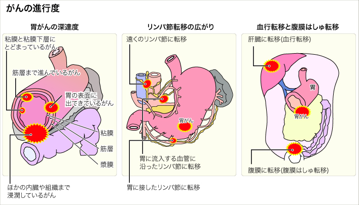 胃がん